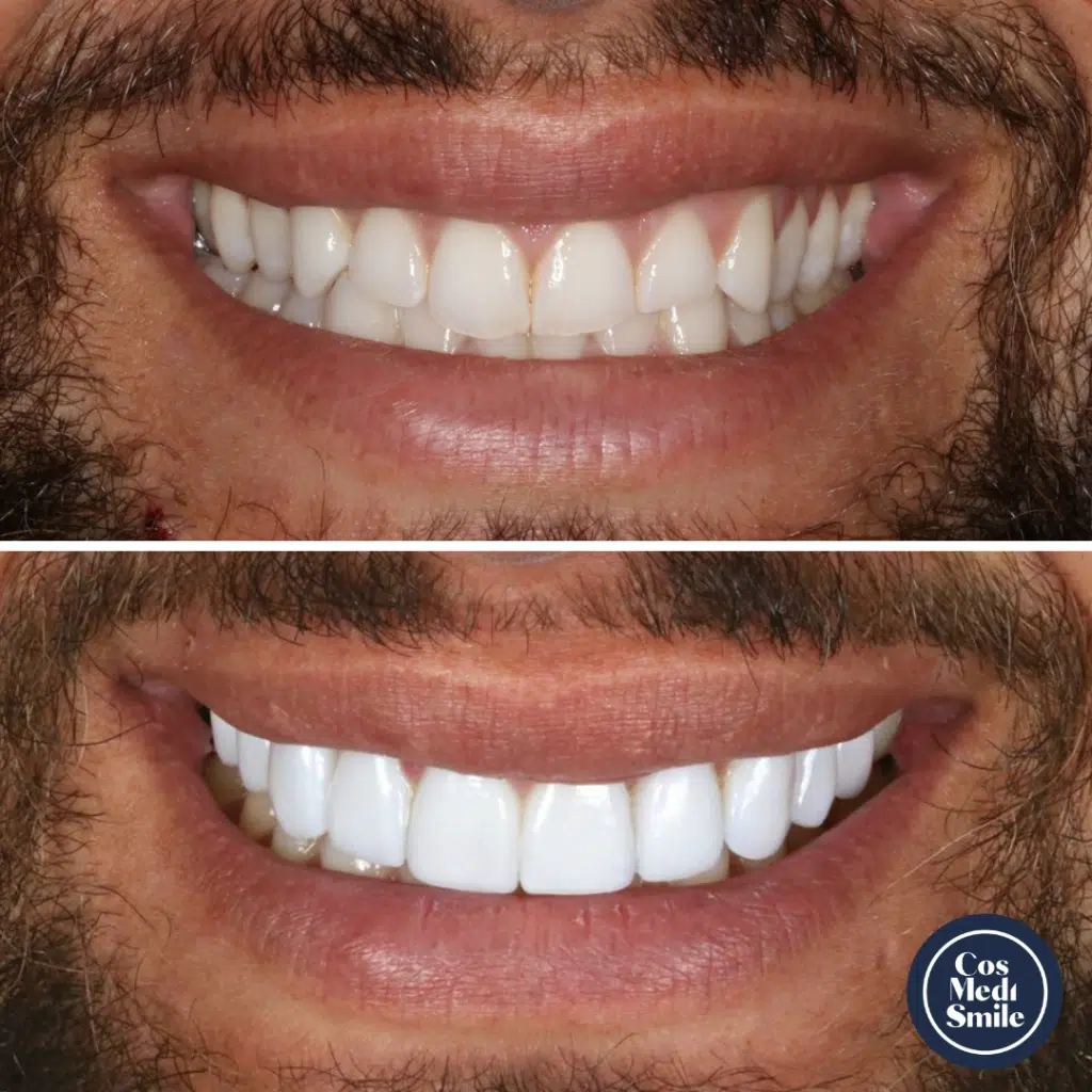 Smile Makeover 10, Porcelain Veneers