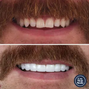 Smile Makeover 11, Dental Crowns