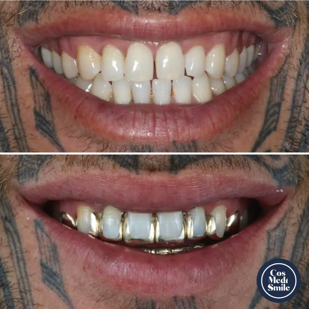 Smile Makeover 12, Gold Crowns