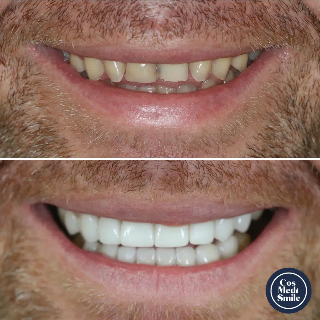 Smile Makeover 13, Porcelain Veneers