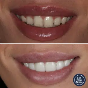 Smile Makeover 16, Porcelain Veneers