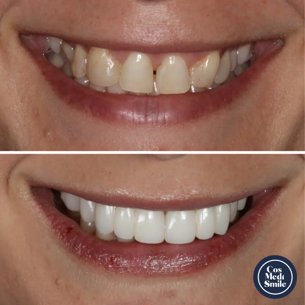 Smile Makeover 17, Dental Crowns