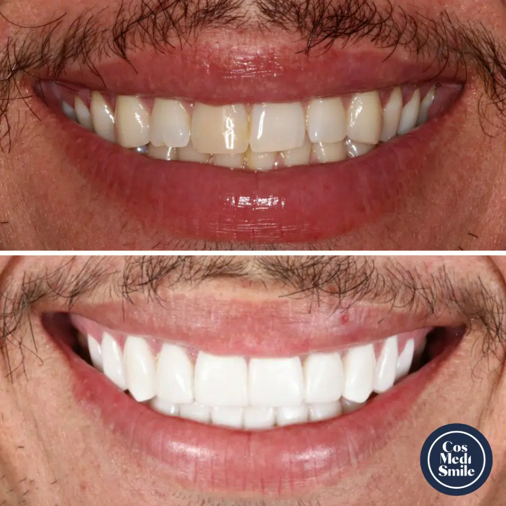 Smile Makeover 2, Porcelain Veneers