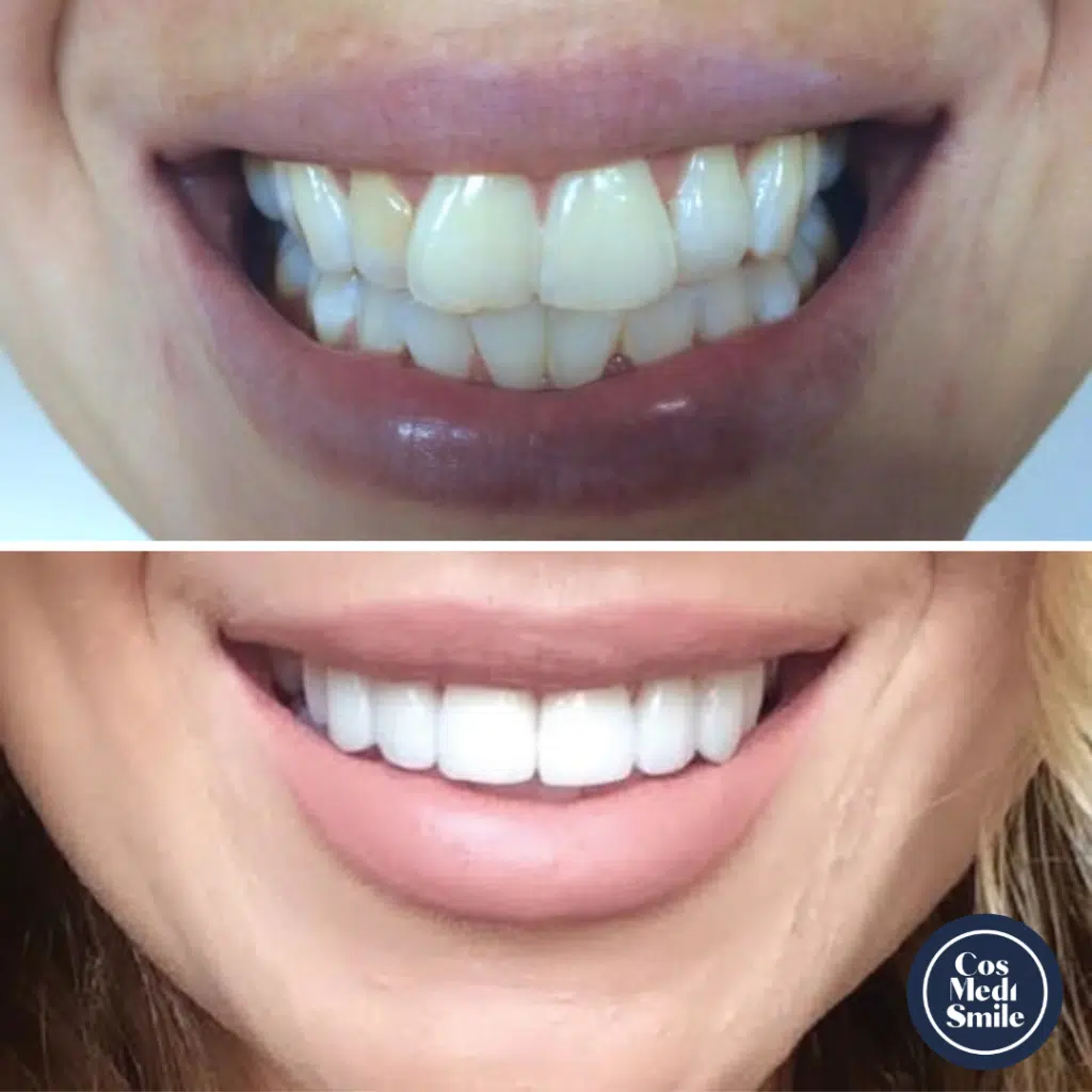 Smile Makeover 3, Porcelain veneers