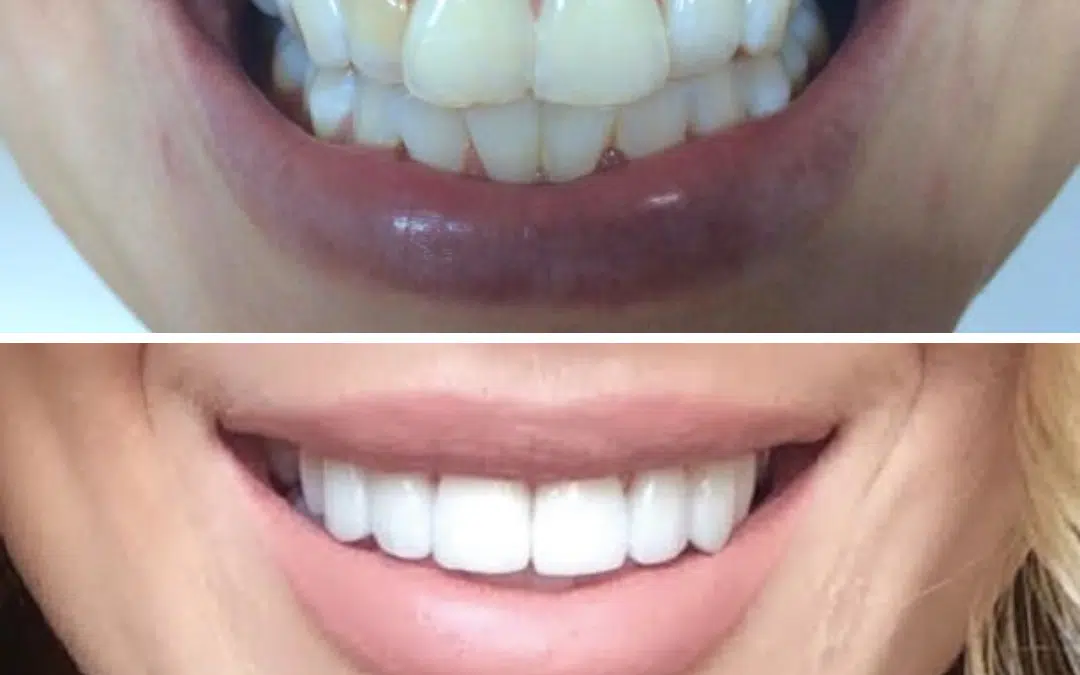 Smile Makeover 3