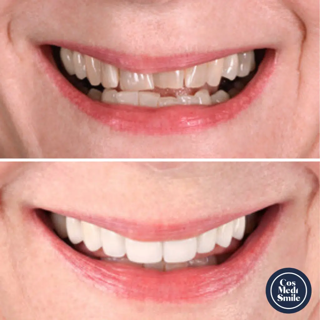 Smile Makeover 6, Porcelain Veneers