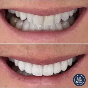 Smile Makeover 8, Dental Crowns