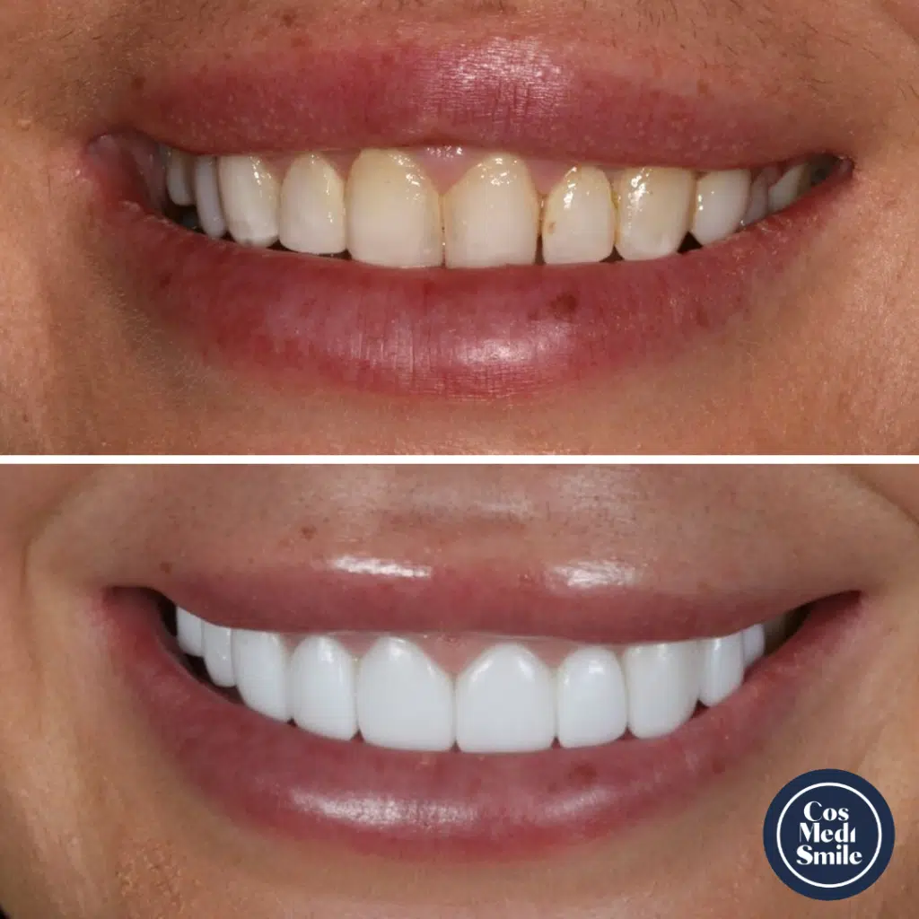 Smile Makeover 9, Porcelain Veneers