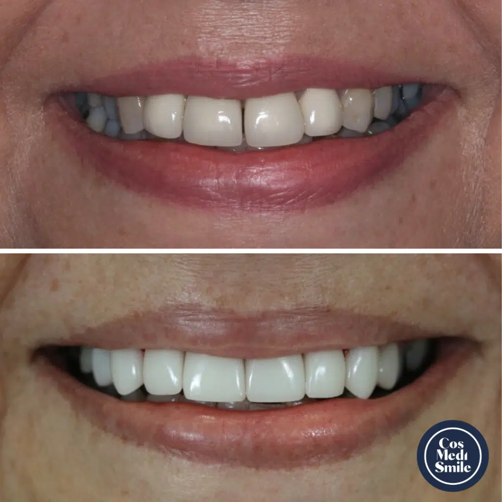 Smile makeover 22, Dental Crowns