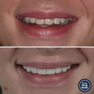 Smile Makeover 24, veneers