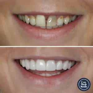 Smile Makeover 26, Veneers