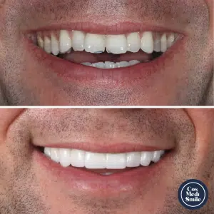 Smile Makeover 27. Dental Crowns