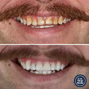 Smile Makeover 28, Dental Crowns