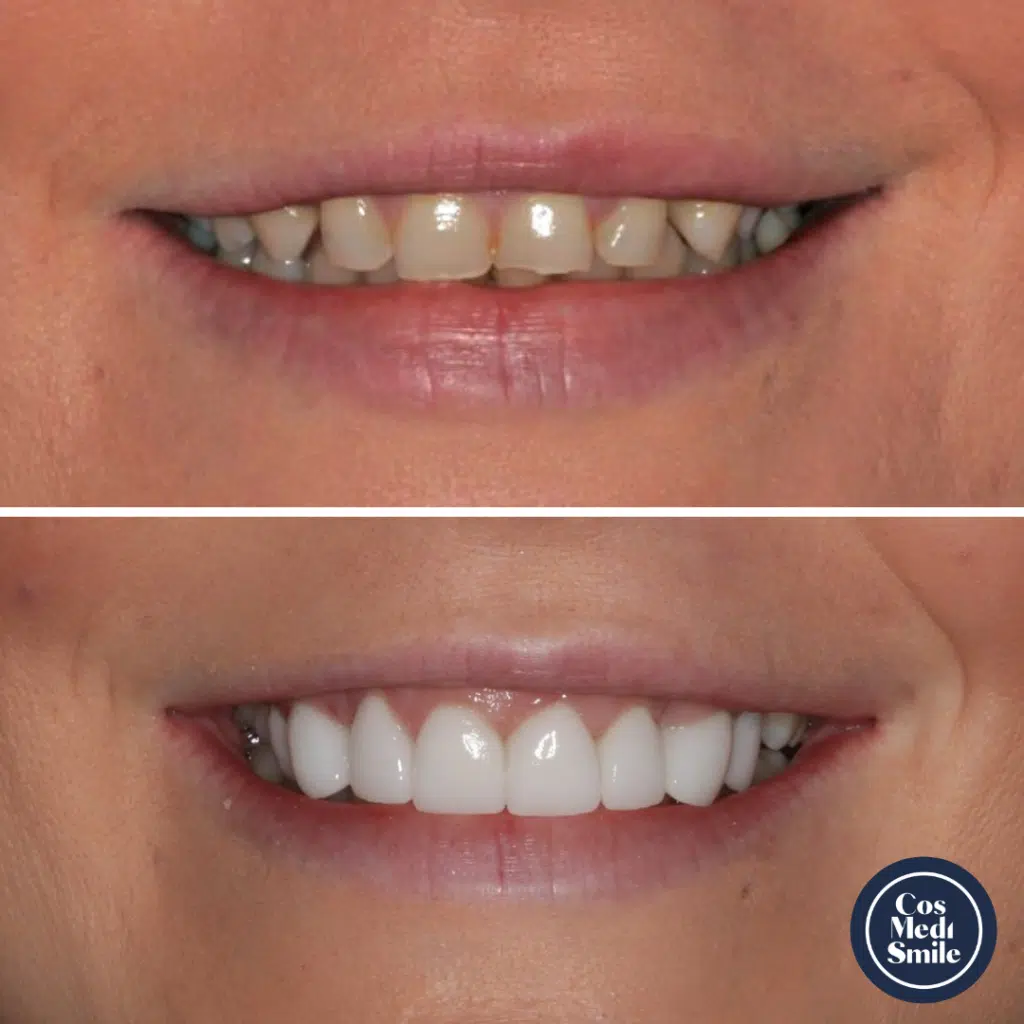 Smile Makeover 29, Dental Crowns