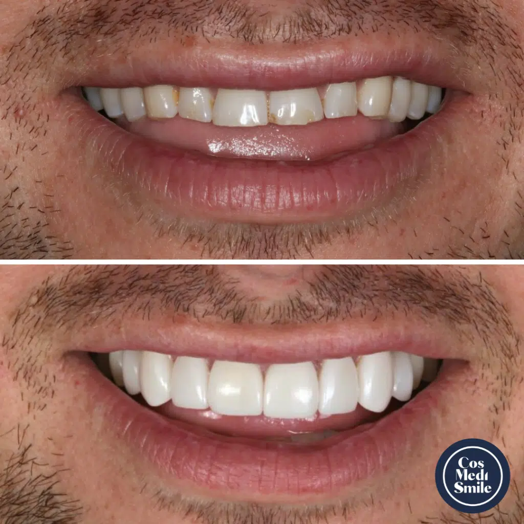 Smile Makeover 30, Porcelain Veneers