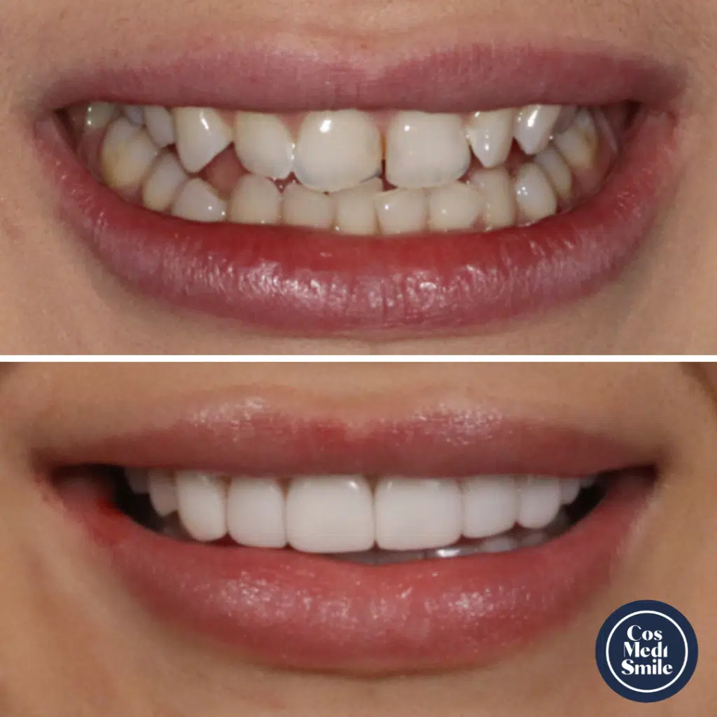 Smile Makeover 31, Porcelain Veneers