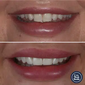 Smile Makeover 34, Porcelain Veneers