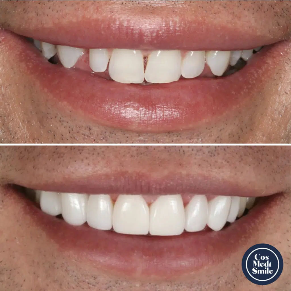 Smile Makeover 36, Porcelain Veneers