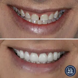 Smile Makeover 38, Dental Crowns