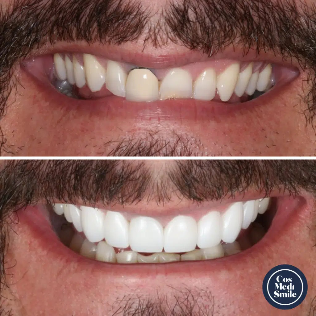 Smile Makeover 39, Dental Crowns