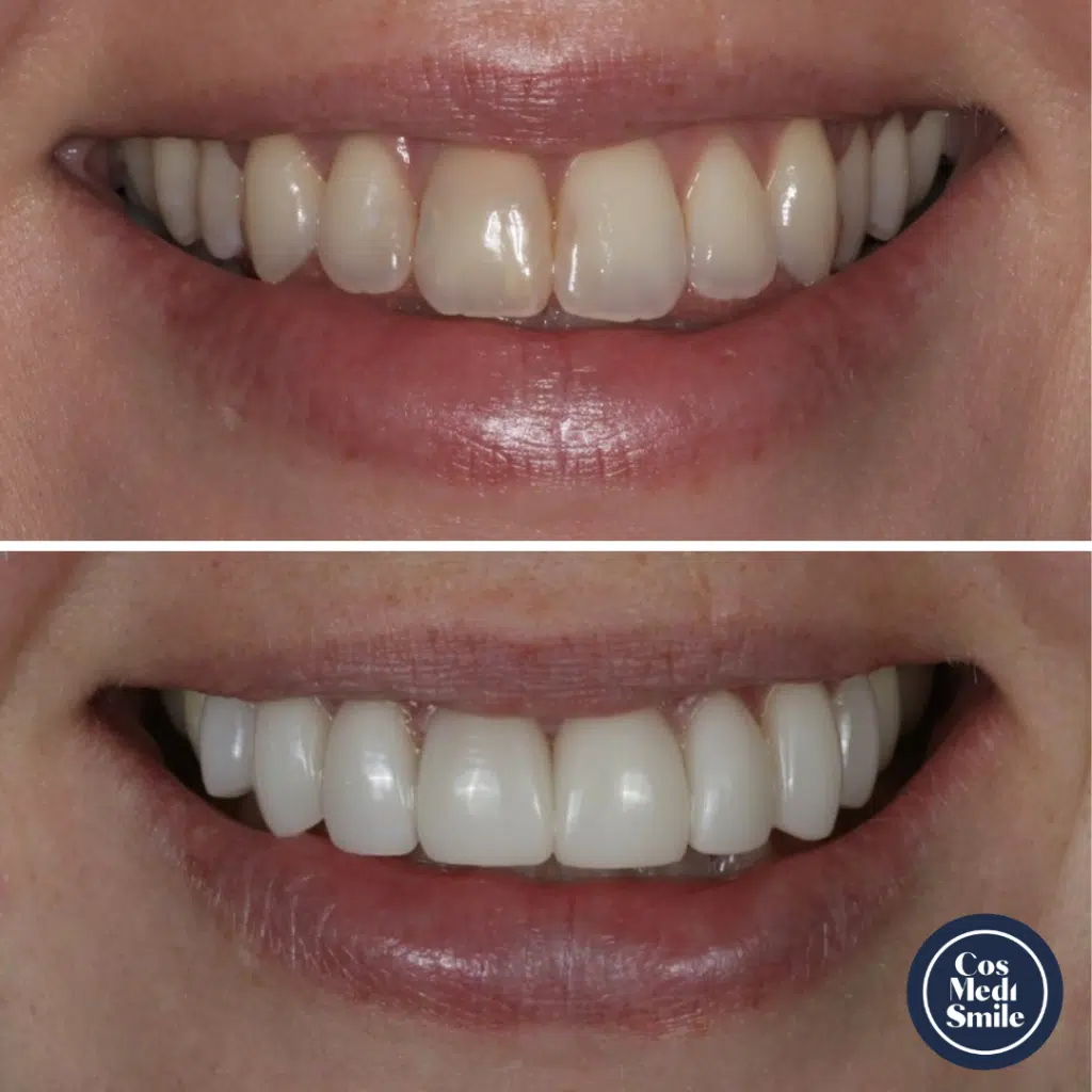 Smile Makeover 40, Porcelain Veneers