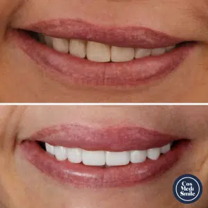 Smile Makeover 41, Porcelain Veneers