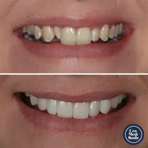 Smile Makeover 44, Dental Crowns