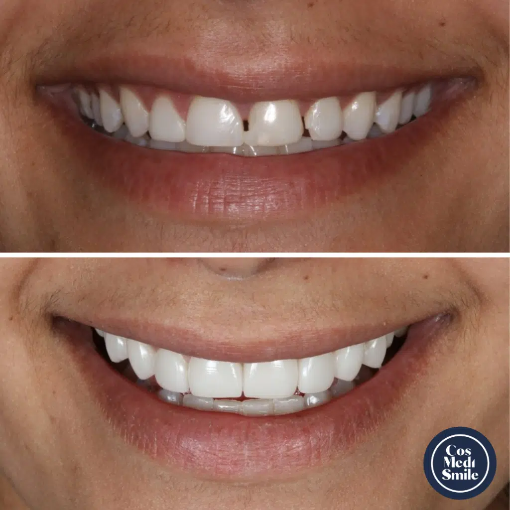 Smile Makeover 45, Porcelain Veneers