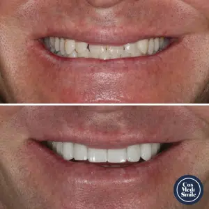 Smile Makeover 47, Porcelain Veneers