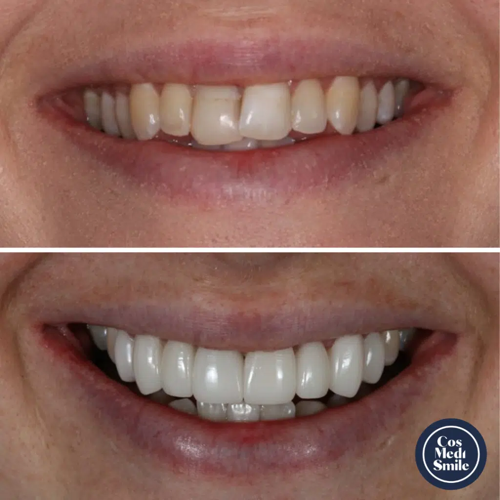 Smile Makeover 47, Veneers and Crowns