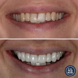 Smile Makeover 47, Veneers and Crowns