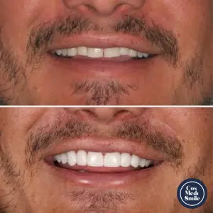 Smile Makeover 48, Porcelain Veneers