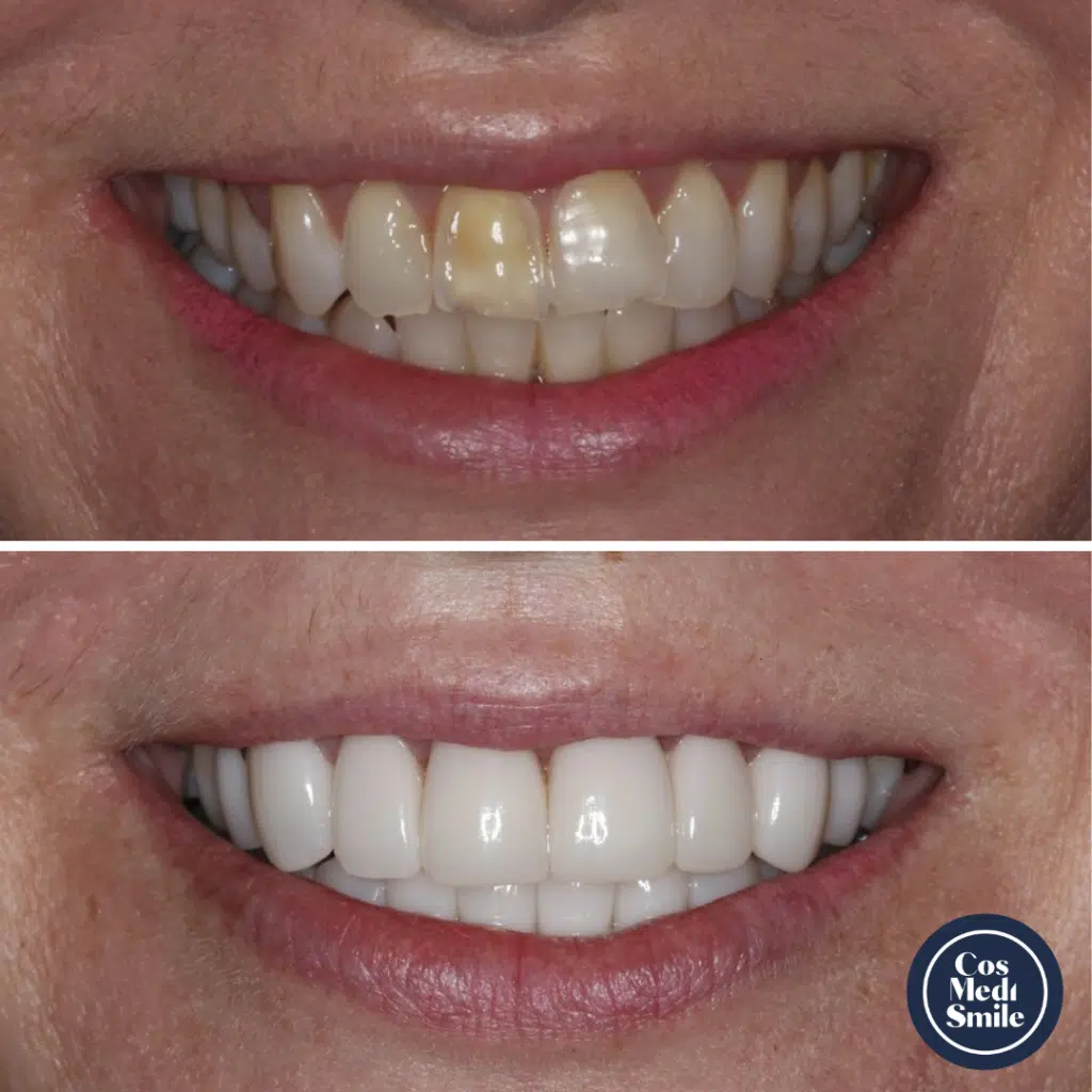 Smile Makeover 50, Dental Crowns