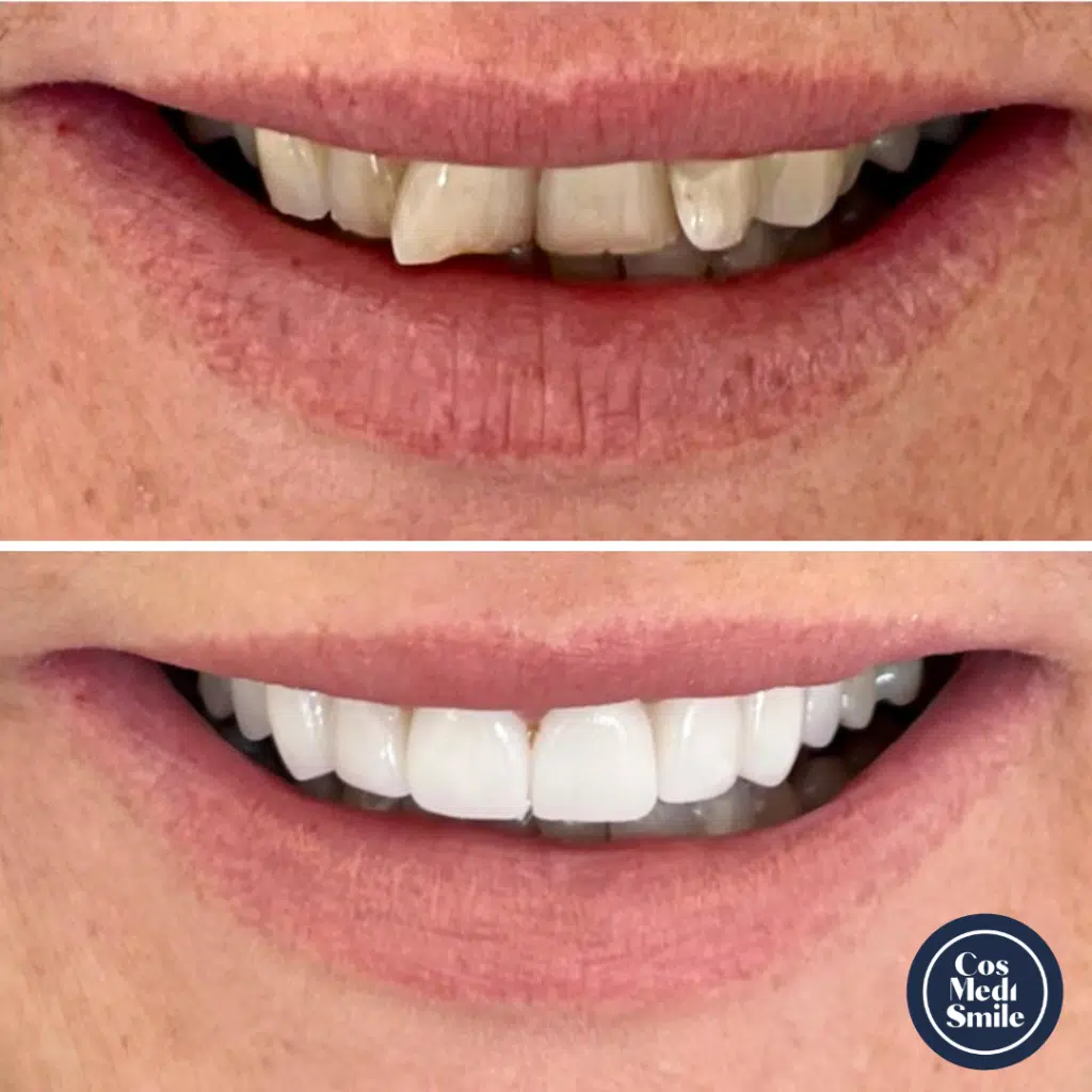 Smile Makeover 53, Dental Crowns