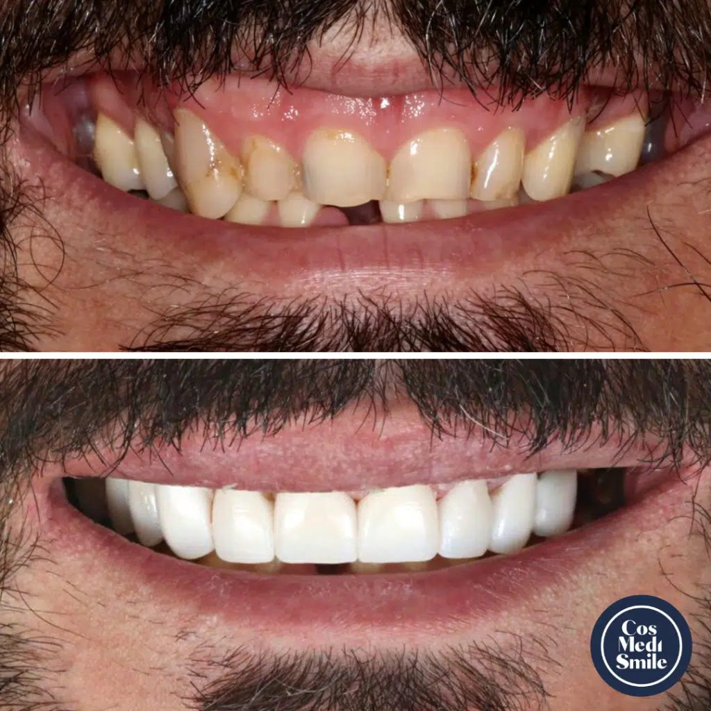 Smile Makeover 56, Dental Crowns