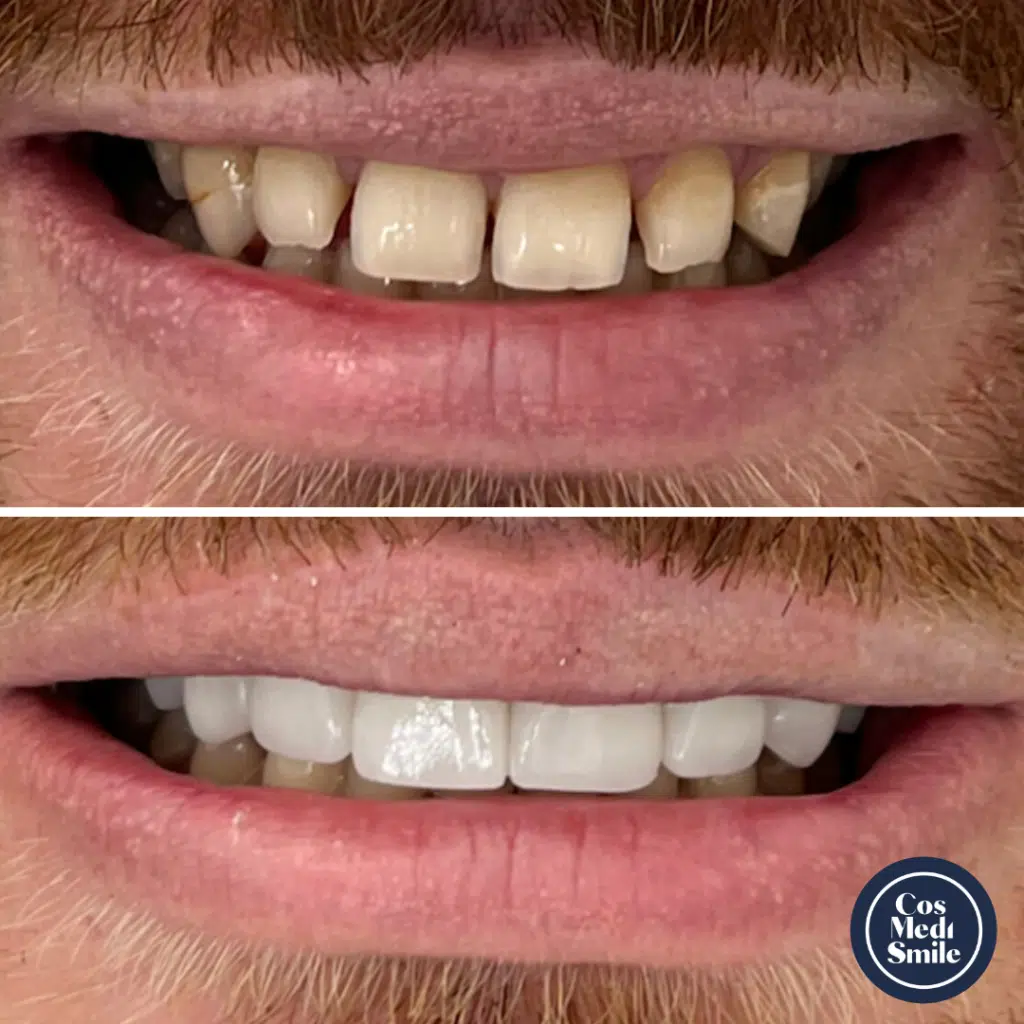 Smile Makeover 59, Dental Crowns