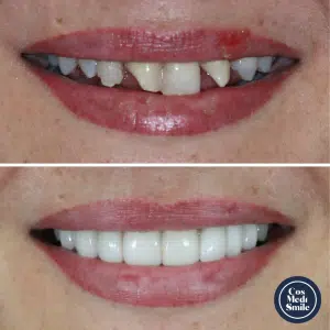 Smile Makeover 61, Dental Crowns