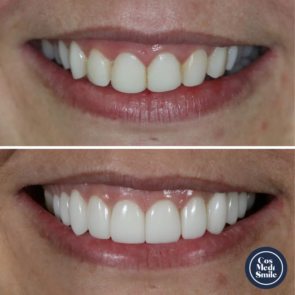 Smile makeover 25, veneers