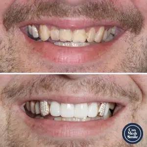 Smile Makeover 68 Dental Crowns