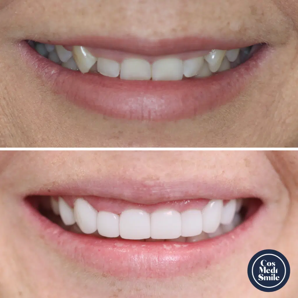 Smile Makeover 70 Porcelain Veneers