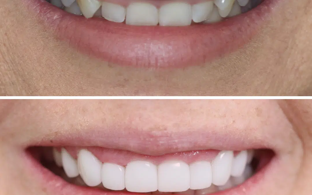 Smile Makeover 70