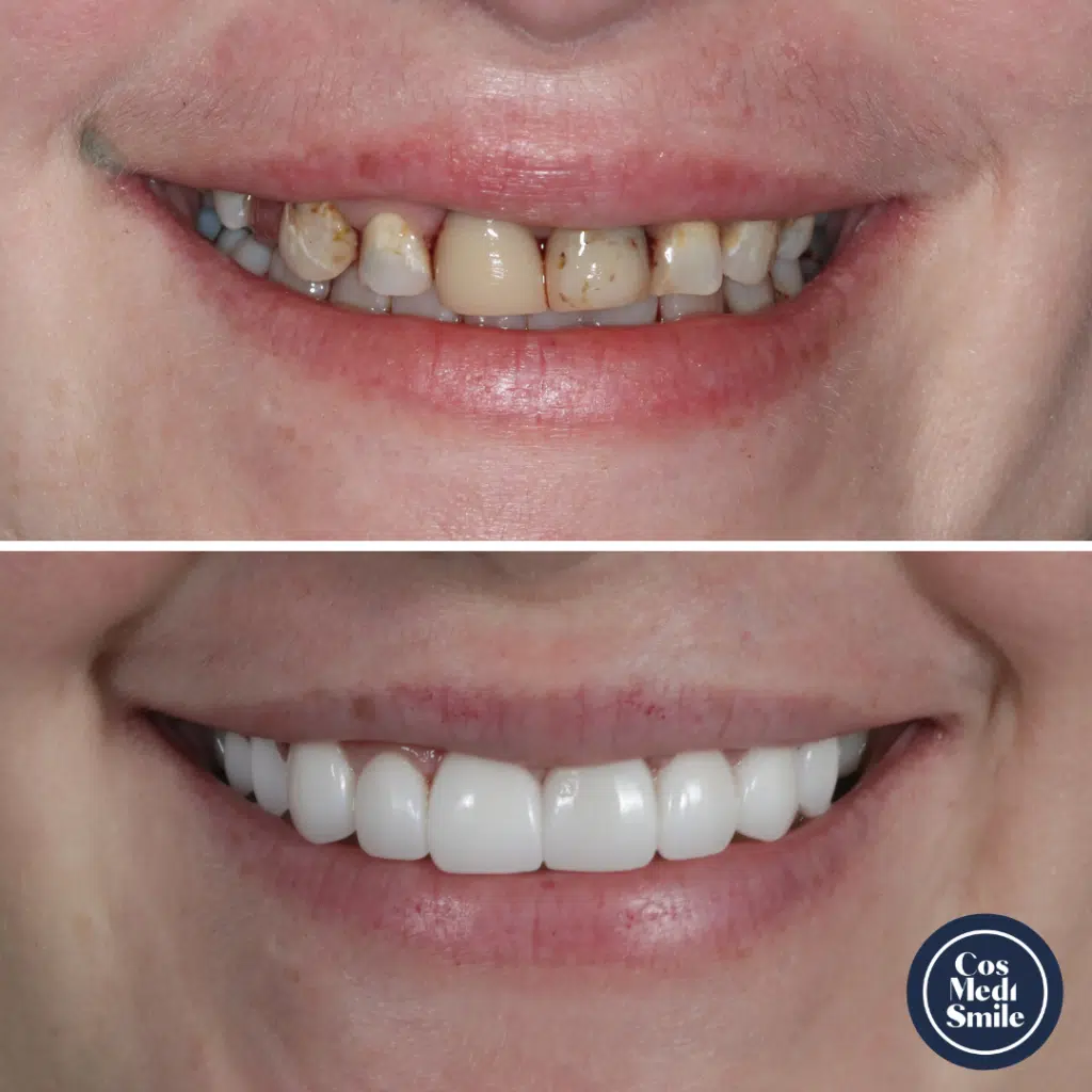 Smile Makeover 72 Dental Crowns