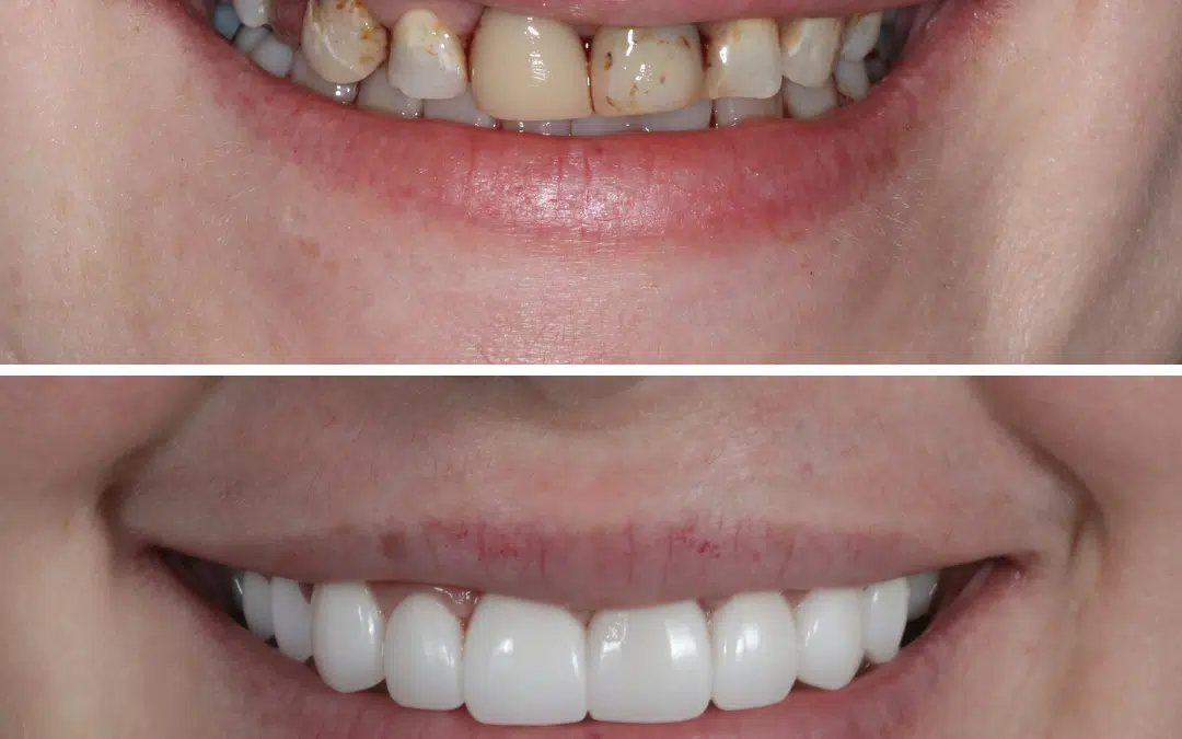 Smile Makeover 71