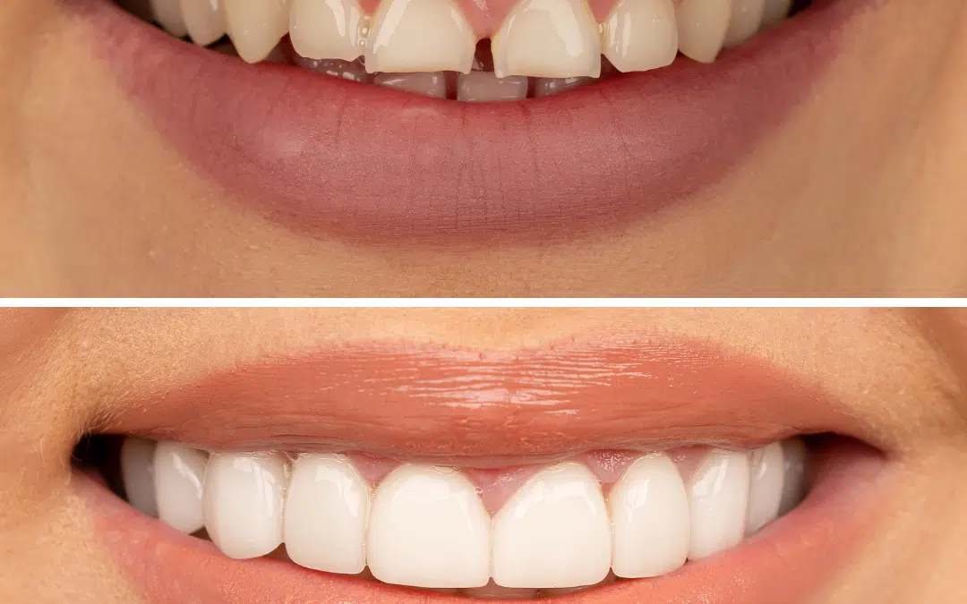 Smile Makeover 72