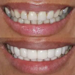 Before and After 55, Veneers