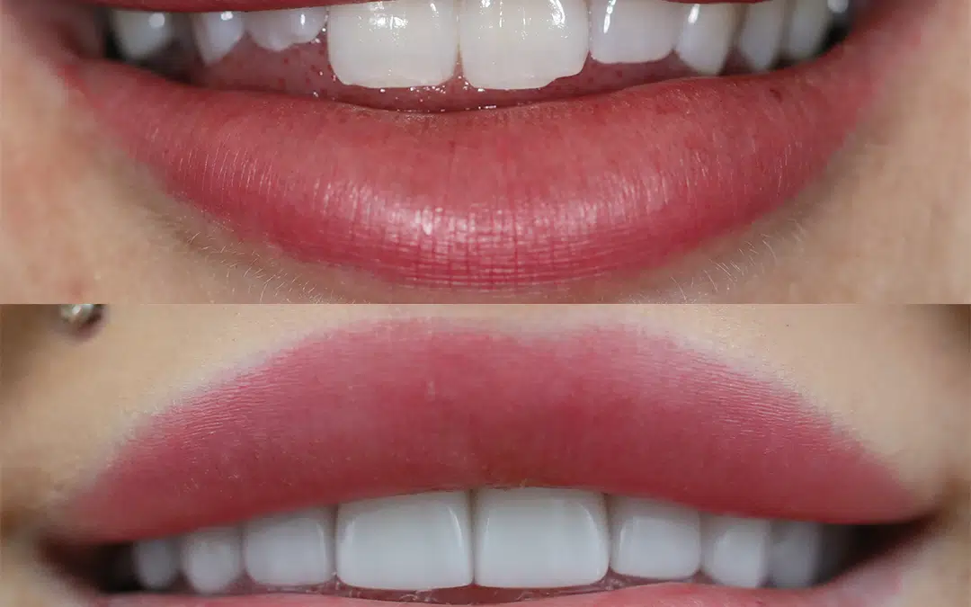 Smile Makeover 75