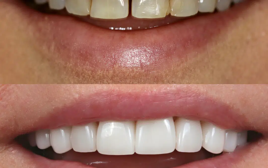 Smile Makeover 79