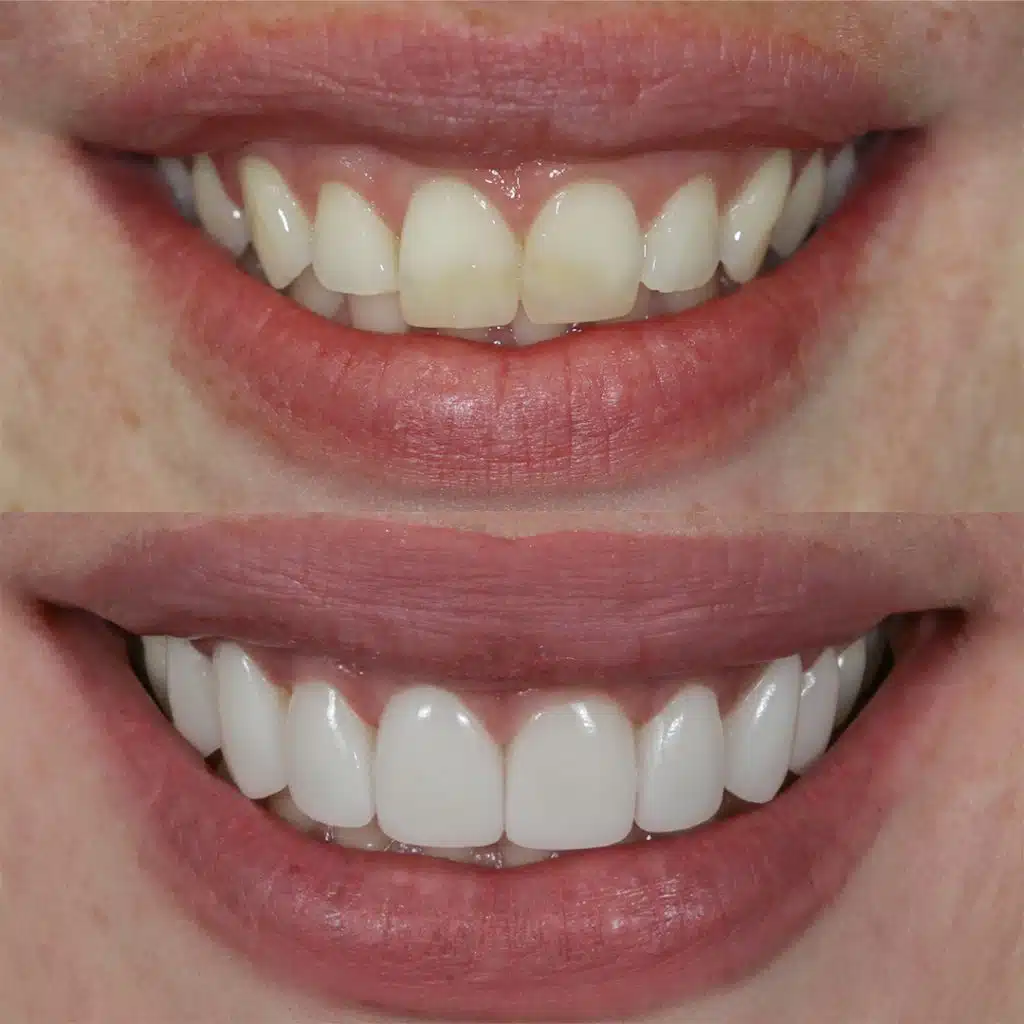 Before-After-80-Veneers