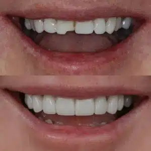 Before-After-84-Crowns