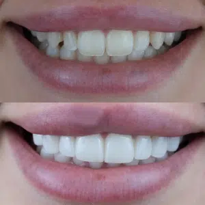 Before-After-86-Veneers